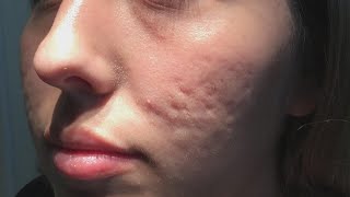 Does This New Procedure Clear up Acne Scars [upl. by Anaej]