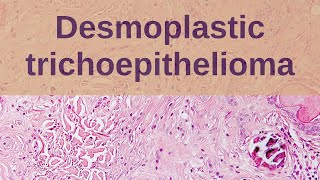 Desmoplastic Trichoepithelioma  Pathology mini tutorial [upl. by Fulviah]