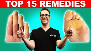 Raynauds Syndrome Top 15 Remedies Symptoms amp Best Treatment [upl. by Ainoek]