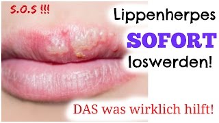 SOS Lippenherpes  SOFORT beseitigen  mein Wundermittel gegen Herpes  Fieberbläschen [upl. by Anifesoj]