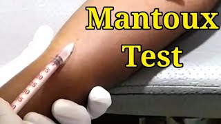 mantoux test  tuberculin skin test [upl. by Akierdna]