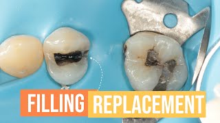 Replace old amalgam restoration [upl. by Atenik]