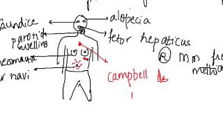 signs of liver cell failure  Hepatobiliary system [upl. by Arvad609]