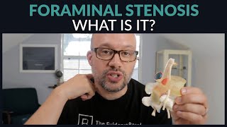 What is Foraminal Stenosis [upl. by Enerehs]