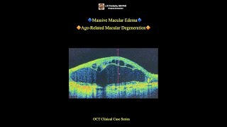 Massive Macular Edema AgeRelated Macular Degeneration [upl. by Ahsinoj]