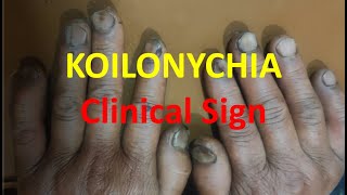 Koilonychia Spoon Nails  Clinical sign [upl. by Swerdna722]