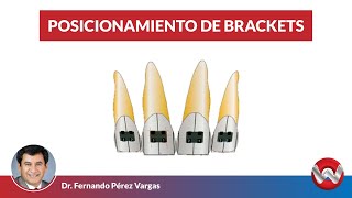 Posicionamiento de Brackets [upl. by Thora]