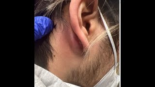 Mastoiditis vs Posterior Auricular Abscess andor Epidermoid Cyst [upl. by Nnomae]