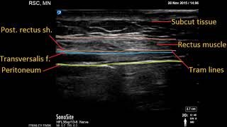 Continuous Rectus sheath block for post laparotomy analgesia [upl. by Boland99]