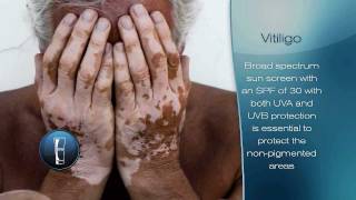 Vitiligo [upl. by Didi]