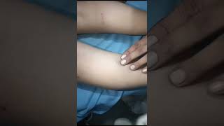 Varicose veins treatment sclerotherapydoctor pain treatment medical [upl. by Ardelis]