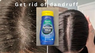 HOW TO GET RID OF DANDRUFF  Selsun Blue Anti Dandruff Shampoo  Honest Review [upl. by Etennaej]