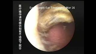 Regular cholesteatoma reexamination and cleaning of the ear [upl. by Anaibaf]