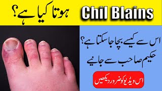 Chilblains Treatment  Swollen hands and fingers in winter  By Hakeem ObaidurRehman [upl. by Brasca]