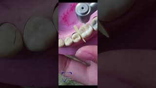 Class 2 cavity preparation for amalgam restoration  بطريقة سهلة وبسيطه شرح بالعربي [upl. by Bonine]