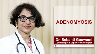 Adenomyosis Symptoms Causes and Treatment  What is Adenomyosis [upl. by Ormand]