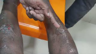 கரப்பான் நோய்  Eczema  Symptoms Treatment and Causes [upl. by Enale977]