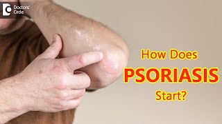 How does psoriasis start Main Causes amp Symptoms  Dr Chaithanya K S  Doctors Circle [upl. by Ormand]