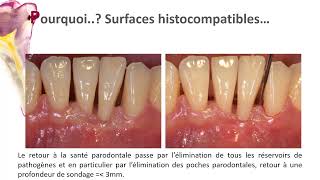 le Détartrage surfaçage radiculaire Un acte de bonne pratique [upl. by Retsevel484]