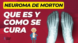 NEUROMA DE MORTON QUE ES Y COMO SE CURA 🦶💥 [upl. by Liamsi]