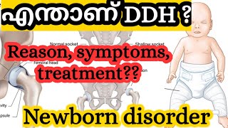 DDH Developmental dysplasia of hipcongenital dislocation of hip  Newborn babies  Malayalam [upl. by Dyl]