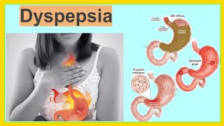 dyspepsia [upl. by Flin]