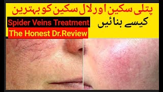 Spider veins treatment  patli skin ki problem ko solved Kry  the honest Dr review [upl. by Seraphim]