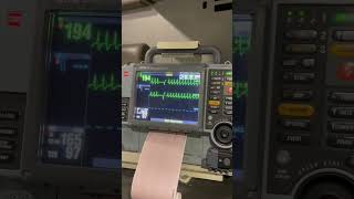 Heart rate 200 Cardioversion with Adenosine [upl. by Trinity730]