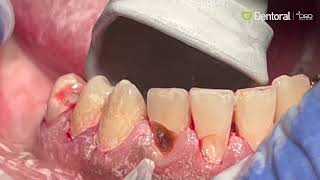 AquaCare Caries Removal [upl. by Howzell584]