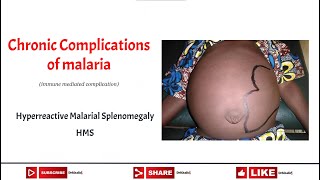 Hyperreactive Malarial Splenomegaly HMS [upl. by Zola]