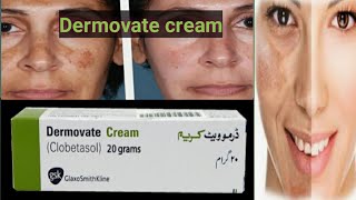 Dermovate Cream Review  Uses  Dermovate cream for skin whitening [upl. by Eboj]