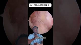 ACL Reconstruction [upl. by Chi]