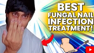 NAKHUN MAI NAIL FUNGUS HO GYA😭Nail fungus treatmentNail fungus infectionNail Splitting treatment [upl. by Chantal311]