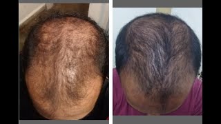 Reverse Male Pattern Baldness Naturally [upl. by Kovar]