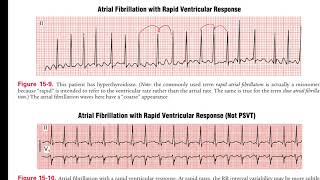 Atrial Fibrilasi Atrial Flutter dan Atrial Tachycardia [upl. by Maffa139]