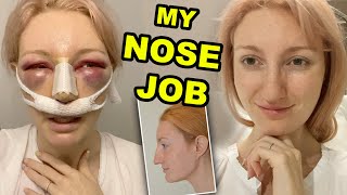 MY NOSE JOB  PART 1  RHINOPLASTY amp SEPTOPLASTY SURGERY amp RECOVERY 2020 [upl. by Ylrehs]