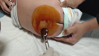 Lumbar puncture LP procedure  Spinal fluid tap [upl. by Melton480]