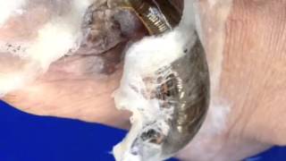 Leech Therapy in skin disease [upl. by Aneekas]