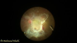 Unimanual vitrectomy in tractional retinal detachment [upl. by Yecniuq17]