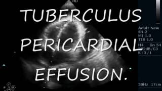 TUBERCULUS PERICARDIAL EFFUSION  ECHOCARDIOGRAPHY SERIES BY DR ANKUR K CHAUDHARI [upl. by Brine]