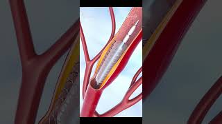 Coronary angioplasty and Stent insertion 3Dvideo animayion [upl. by Cynthie]