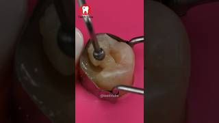 Root Canal Treatment shorts [upl. by Sianna]