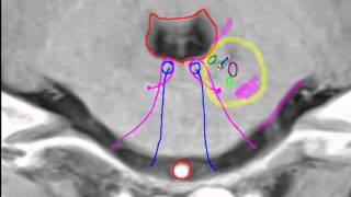 Anterior inferior cerebellar artery [upl. by Hemingway]