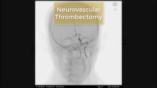 Mentice Neurovascular Thrombectomy [upl. by Justine]