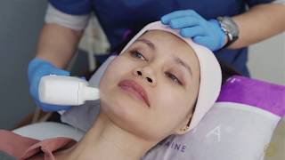 What is HIFU treatment  Instant Facelift without surgery [upl. by Reinert593]