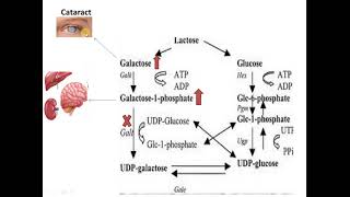 Galactosemia Galactose metabolism disorder [upl. by Janyte103]