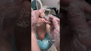 Treatment Callus and Dead skin Ep19  Sheng Clinic [upl. by Ailsa392]