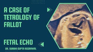 Tetrology of Fallot  Fetal echocardiography  Dr Surbhi Gupta Aggarwal [upl. by Duleba]