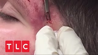 Zyste muss aus Gesicht entfernt werden  Dr Pimple Popper  TLC Deutschland [upl. by Ecnedurp]