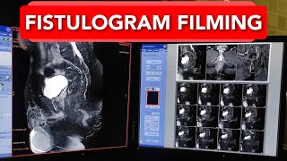 Fistulogram MRI scan Filming Technique [upl. by Holmann]